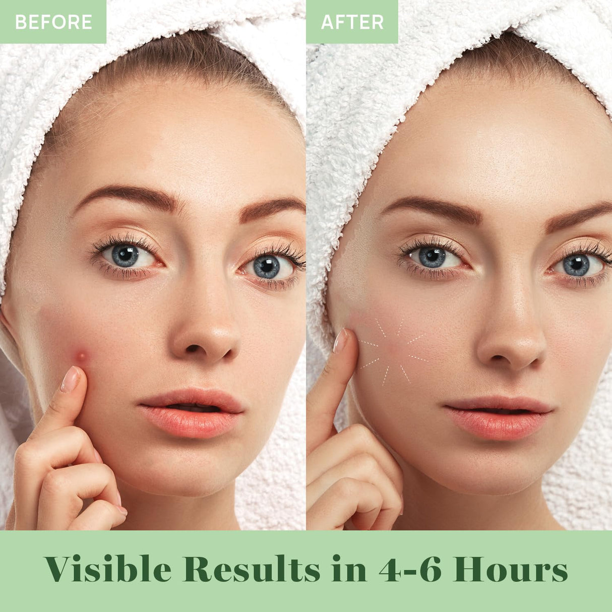 Absorbing Cover Healing Invisible Acne Patch Blemish Spot, Treatment, Facial Acne Patch Vegan, Cruelty Free, Hydrocolloid, Two Sizes 10mm 12mm (Total 84 Counts)